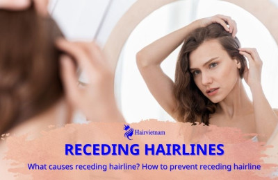 Receding Hairlines: Causes and Tips for Prevention